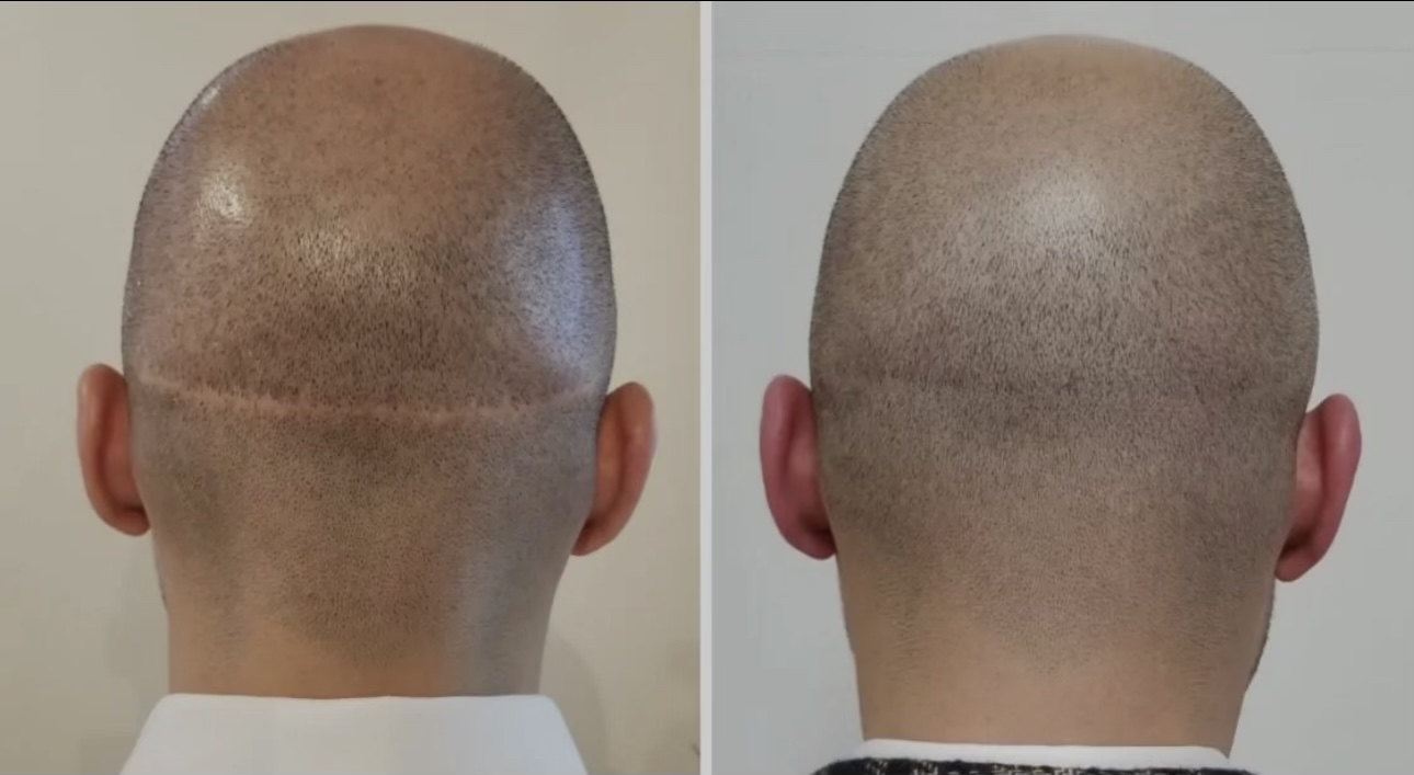 Scalp micropigmentation and hair transplant scars